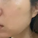 肌育注射（ジュベルックなど） BAO CLINIC 梅田院 AFTER サムネイル用