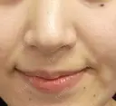 ヒアルロン酸注入（鼻翼基部） eクリニック 大阪院 AFTER サムネイル用
