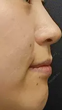 ヒアルロン酸注入（鼻翼基部） eクリニック 大阪院 DAY 0 サムネイル用