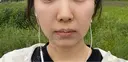 脂肪吸引（顔） ルラ美容クリニック 名古屋栄院 / ルラスキンクリニック 名古屋栄院 DAY 14 サムネイル用