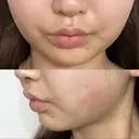 脂肪吸引注射（顔） EMMO FACE CLINIC 東京三田院 AFTER サムネイル用