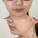 脂肪吸引注射（顔） EMMO FACE CLINIC 東京三田院 DAY 1 サムネイル用