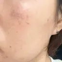 イオン導入 / ピーリング（ハリ・ツヤ） / ルメッカ ルラ美容クリニック 静岡院 DAY 7 サムネイル用