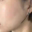 イオン導入 / ピーリング（ハリ・ツヤ） / ルメッカ ルラ美容クリニック 静岡院 DAY 7 サムネイル用