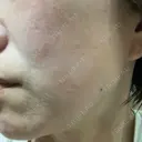 イオン導入 / ルメッカ ルラ美容クリニック 大宮院 / ルラスキンクリニック 大宮院 DAY 5 サムネイル用