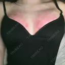 脂肪吸引（脚） / 豊胸（脂肪注入） Bloom Delight Clinic DAY 0 サムネイル用