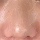 鼻尖形成（切開） / 小鼻縮小（切開） / 軟骨移植 ブルームクリニック（BLOOM CLINIC） DAY 10 サムネイル用