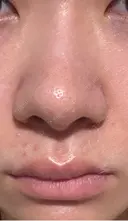 鼻尖形成（切開） / 軟骨移植 / 鼻柱下降・鼻唇角形成（猫手術） 東京美専クリニック DAY 18 サムネイル用