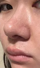 鼻尖形成（切開） / 軟骨移植 / 鼻柱下降・鼻唇角形成（猫手術） 東京美専クリニック DAY 18 サムネイル用