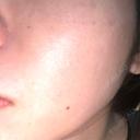 ピーリング（ハリ・ツヤ） / ルメッカ PureMe Skin Clinic（ピュアミースキンクリニック麻布） AFTER サムネイル用