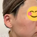 ヴェルヴェットスキン ゆう美容クリニック DAY 3 サムネイル用