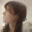 ヒアルロン酸注入（鼻） TCB東京中央美容外科 青森院 DAY 0 サムネイル用