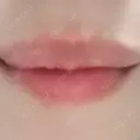 ヒアルロン酸注入（唇） / ヒアルロン酸注入（目の下） KIMI CLINIC 形成・美容外科 AFTER サムネイル用