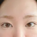 その他（目元） 東京形成美容外科 船橋院 AFTER サムネイル用