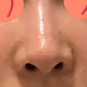 鼻尖形成（切開） / 骨削り（頬） / 軟骨移植 / 鼻孔縁挙上 THE ROPPONGI CLINIC（ザ 六本木クリニック） AFTER サムネイル用