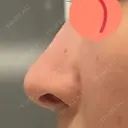 鼻尖形成（切開） / 骨削り（頬） / 軟骨移植 / 鼻孔縁挙上 THE ROPPONGI CLINIC（ザ 六本木クリニック） DAY 391 サムネイル用