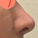 鼻尖形成（切開） / 骨削り（頬） / 軟骨移植 / 鼻孔縁挙上 THE ROPPONGI CLINIC（ザ 六本木クリニック） DAY 391 サムネイル用