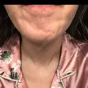 ボトックス（あご） / ボトックス（目尻） ルラ美容クリニック 新宿院 DAY 0 サムネイル用