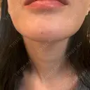 ボトックス（あご） / ボトックス（目尻） ルラ美容クリニック 新宿院 DAY 0 サムネイル用