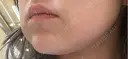 ボトックス（あご） / ボトックス（エラ・小顔） / 脂肪溶解注射（顔） / ボトックス（人中） Kinshicho Beauty Clinic （錦糸町ビューティークリニック） DAY 0 サムネイル用