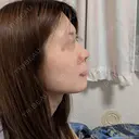 ヒアルロン酸注入（鼻） TCB東京中央美容外科 青森院 DAY 4 サムネイル用