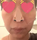 ハイフ（顔） しんゆり美容健康クリニック AFTER サムネイル用