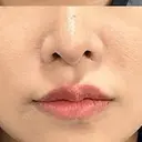 ヒアルロン酸注入（鼻翼基部） BIZENNクリニック【ビゼンクリニック】 AFTER サムネイル用