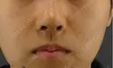隆鼻術 / 鼻尖形成（切開） / 鼻中隔延長（切開） GRACIA clinic 【グラシアクリニック】 DAY 7 サムネイル用
