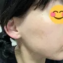 ヴェルヴェットスキン ゆう美容クリニック AFTER サムネイル用