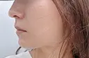 糸リフト 目白ホワイトクリニック DAY 21 サムネイル用