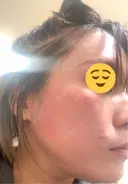 医療脱毛（顔） ZX-CLINIC 梅田院 DAY 1 サムネイル用