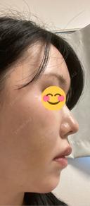 ヒアルロン酸注入（鼻） プリモ麻布十番クリニック AFTER サムネイル用
