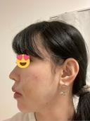 ヒアルロン酸注入（鼻） プリモ麻布十番クリニック DAY 1 サムネイル用
