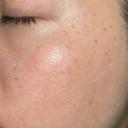 ピーリング（ハリ・ツヤ） / ルメッカ PureMe Skin Clinic（ピュアミースキンクリニック麻布） DAY 0 サムネイル用