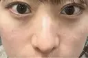 軟骨移植 / 目元修正 / 自然癒着法 / 鼻尖形成（非切開） eクリニック 福岡院 DAY 28 サムネイル用