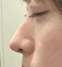 軟骨移植 / 目元修正 / 自然癒着法 / 鼻尖形成（非切開） eクリニック 福岡院 DAY 28 サムネイル用