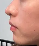 軟骨移植 / 目元修正 / 自然癒着法 / 鼻尖形成（非切開） eクリニック 福岡院 AFTER サムネイル用