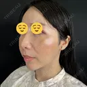 クマ治療 / 脂肪注入（目の下） 藤・ナチュレ美容クリニック 銀座院 DAY 7 サムネイル用