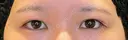 目尻切開 / タレ目形成・グラマラスライン（埋没） LOUIS CLINIC 二子玉川院【ルイクリニック】 AFTER サムネイル用