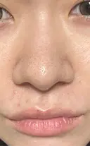 鼻尖形成（切開） / 軟骨移植 / 鼻柱下降・鼻唇角形成（猫手術） 東京美専クリニック AFTER サムネイル用