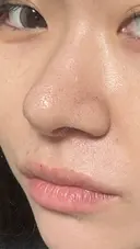 鼻尖形成（切開） / 軟骨移植 / 鼻柱下降・鼻唇角形成（猫手術） 東京美専クリニック DAY 23 サムネイル用