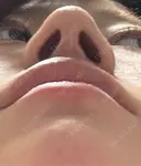 鼻尖形成（切開） / 軟骨移植 / 鼻柱下降・鼻唇角形成（猫手術） 東京美専クリニック DAY 23 サムネイル用