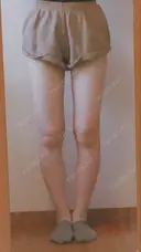 脂肪吸引（脚） ドクターフィット（Dr.fit）クリニック DAY 15 サムネイル用