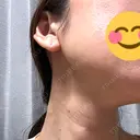 RF（高周波）たるみ治療 Clinic K Blossom AFTER サムネイル用