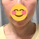 RF（高周波）たるみ治療 Clinic K Blossom DAY 0 サムネイル用