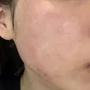 エレクトロポレーション / ルメッカ ON-CLINIC Beauty DAY 0 サムネイル用