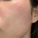 エレクトロポレーション / ルメッカ ON-CLINIC Beauty DAY 0 サムネイル用