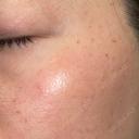 ピーリング（ハリ・ツヤ） / ルメッカ PureMe Skin Clinic（ピュアミースキンクリニック麻布） DAY 1 サムネイル用