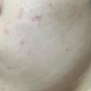 医療脱毛（全身） / ルメッカ Grias clinic （ジリアスクリニック） DAY 2 サムネイル用