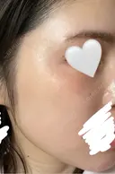 ほくろ・いぼ除去レーザー（肌） / シミ取りレーザー eクリニック 金沢本院 AFTER サムネイル用